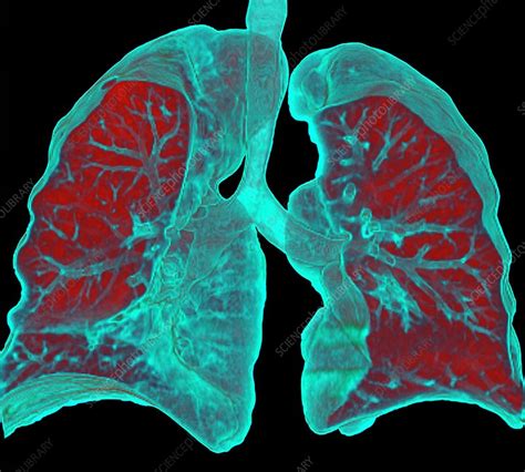 the villages lung ct scan|CT Scan of Lungs .